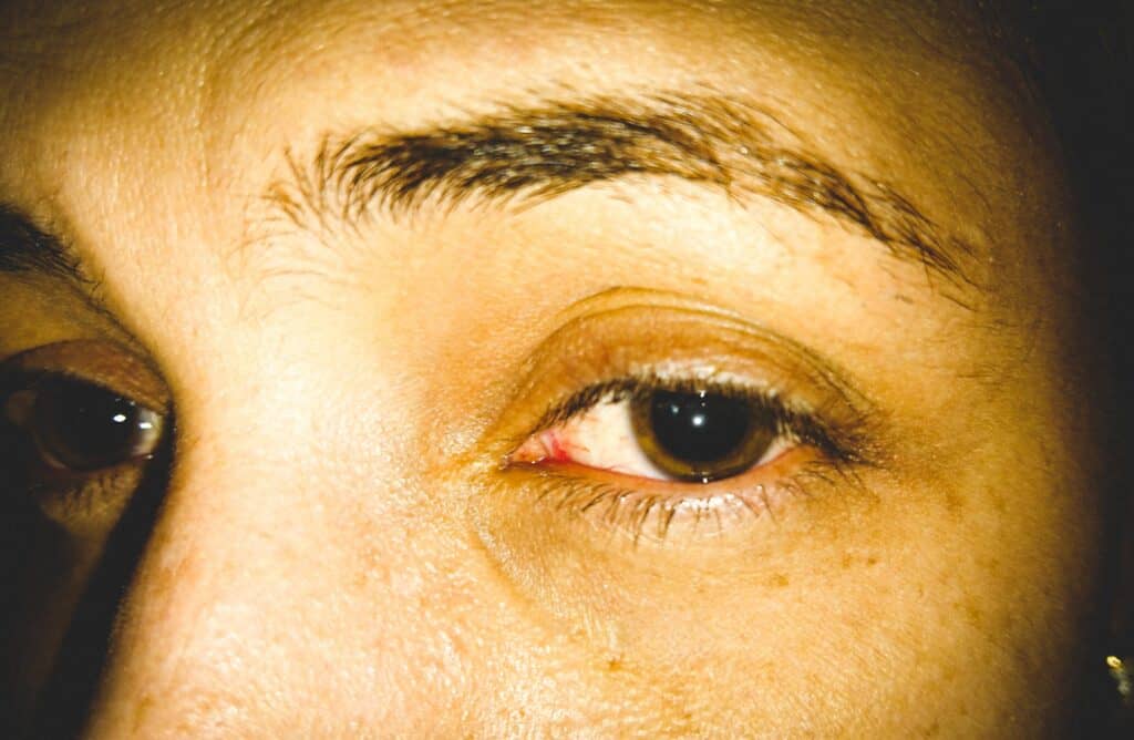 heroin eyes, does heroin dilate pupils, what does heroin do to your eyes