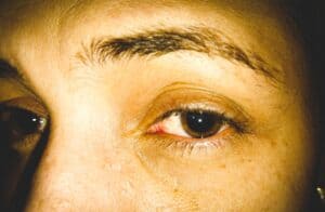 heroin eyes, does heroin dilate pupils, what does heroin do to your eyes